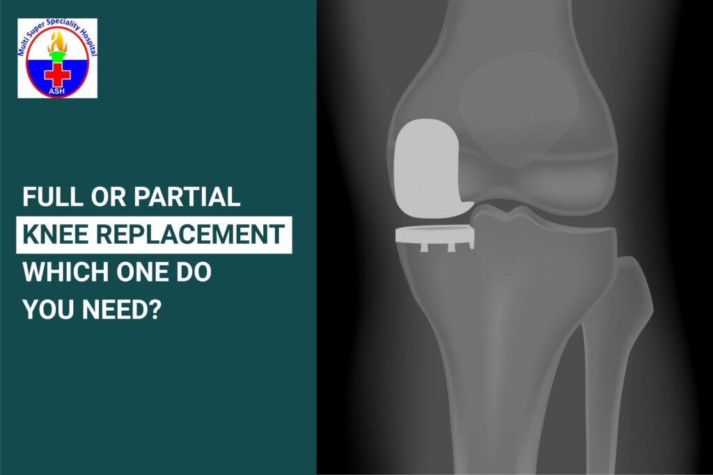 Full or Partial Knee Replacement
