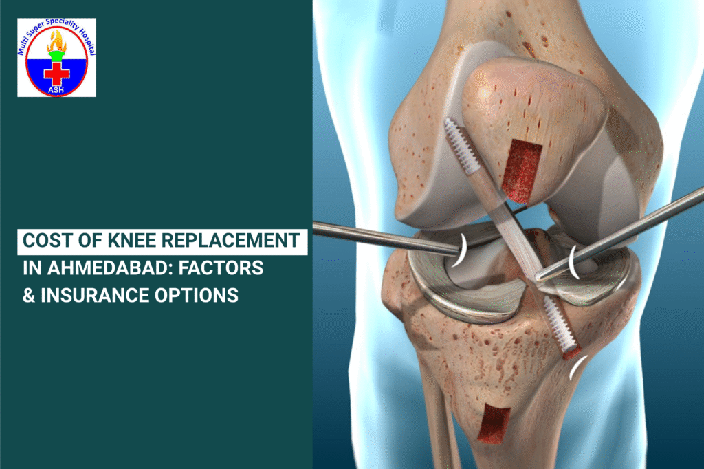 Cost of Knee Replacement in Ahmedabad
