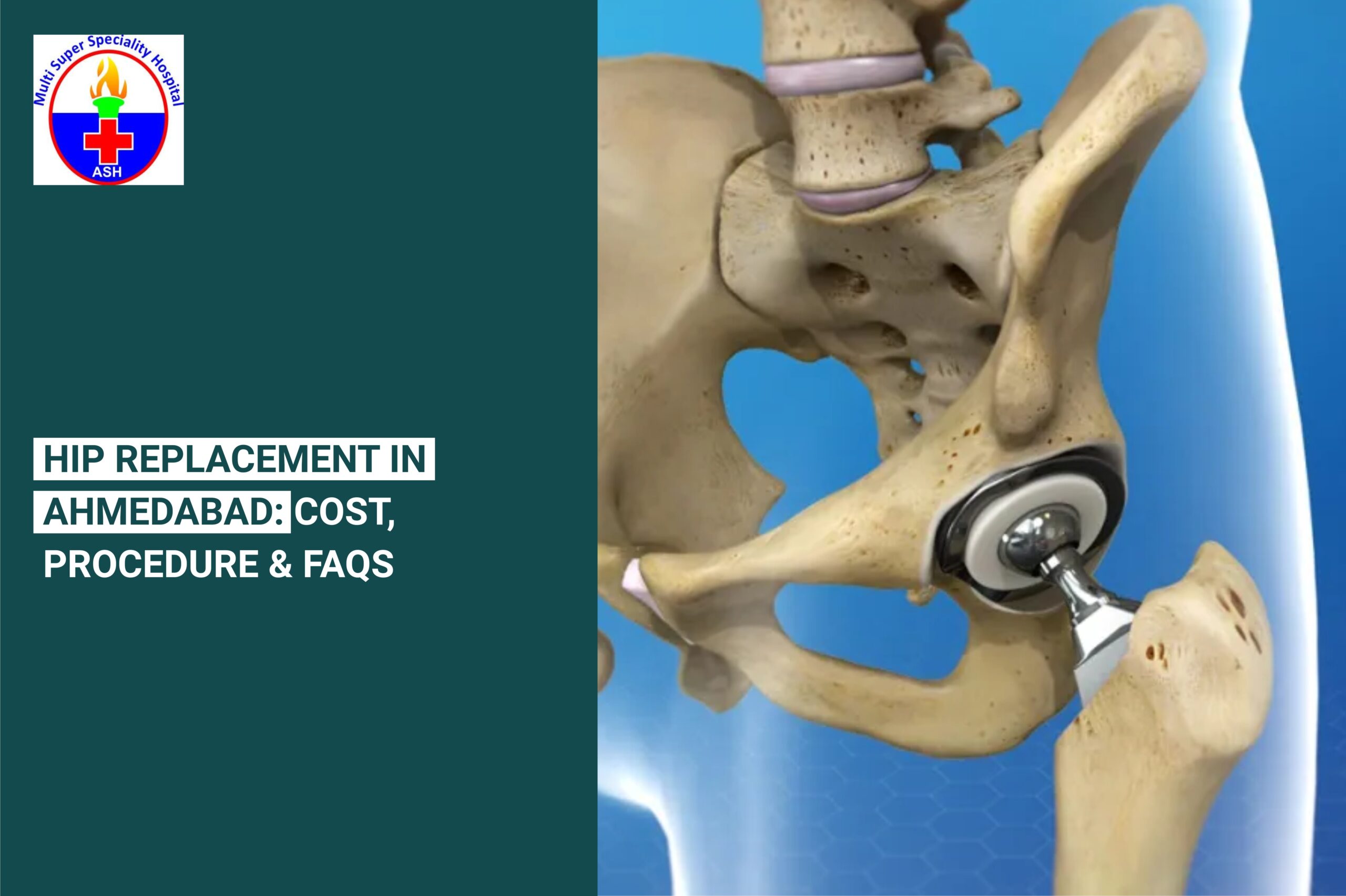 Hip Replacement cost in Ahmedabad