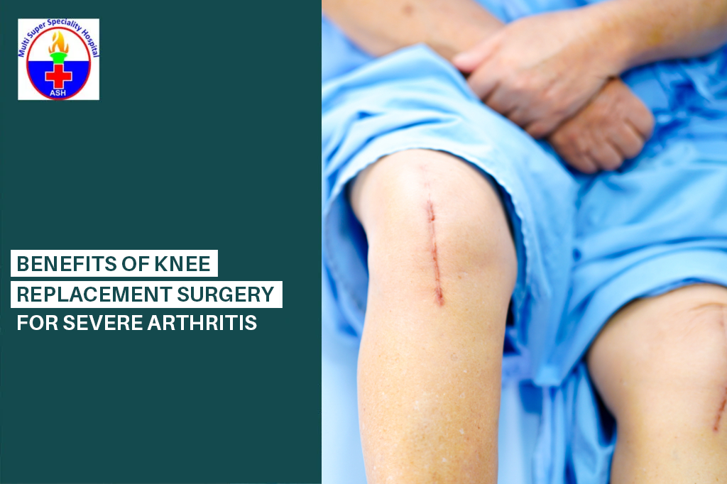Knee Replacement Surgery for Severe Arthritis